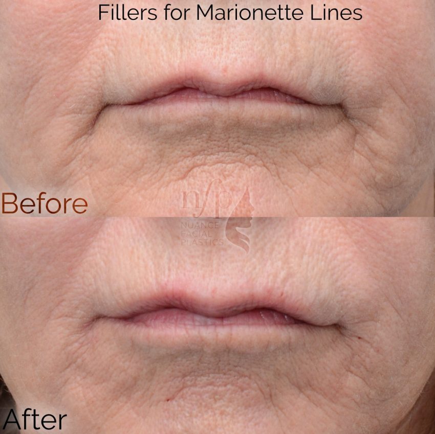 before and after filler marionette lines