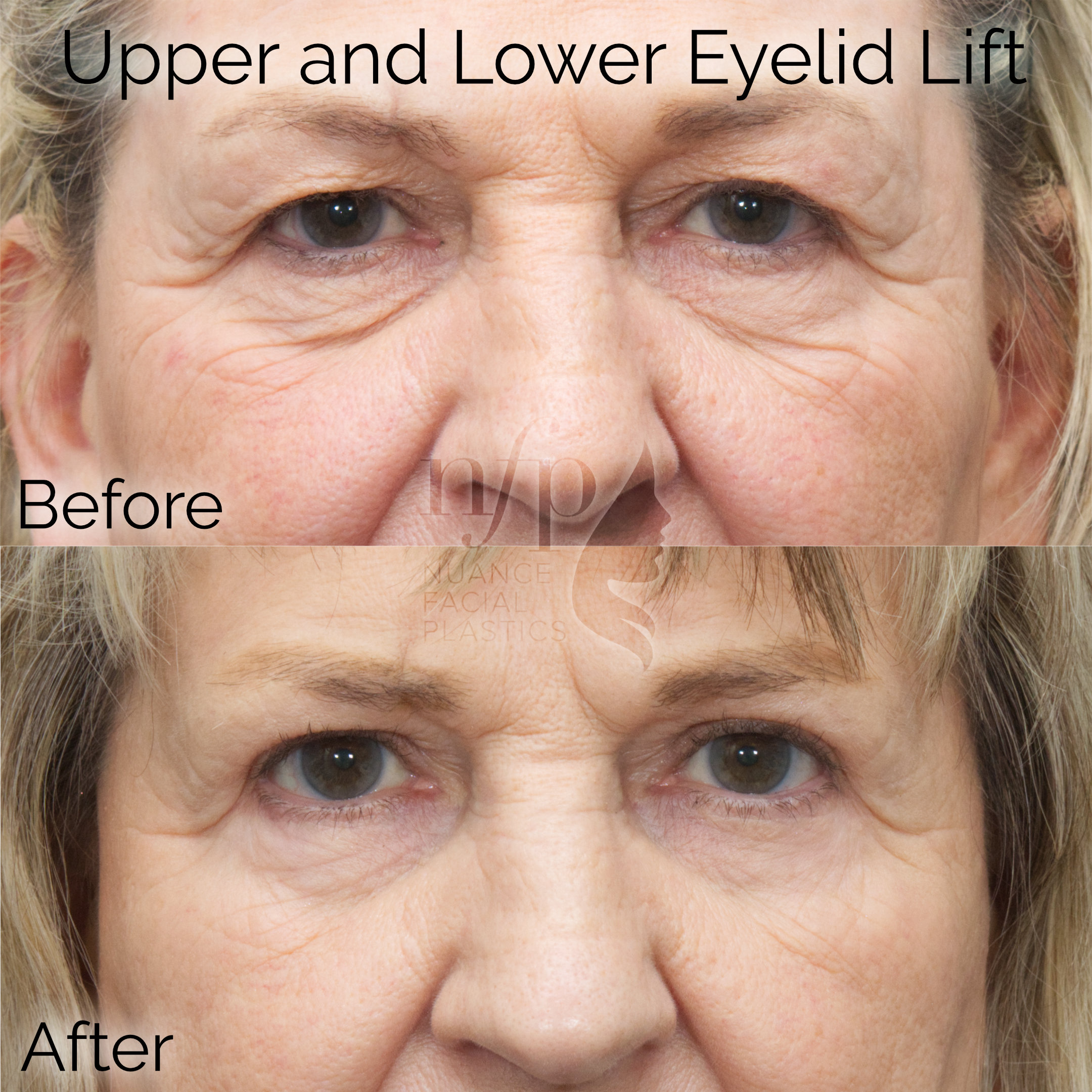 front view upper and lower eyelid lift