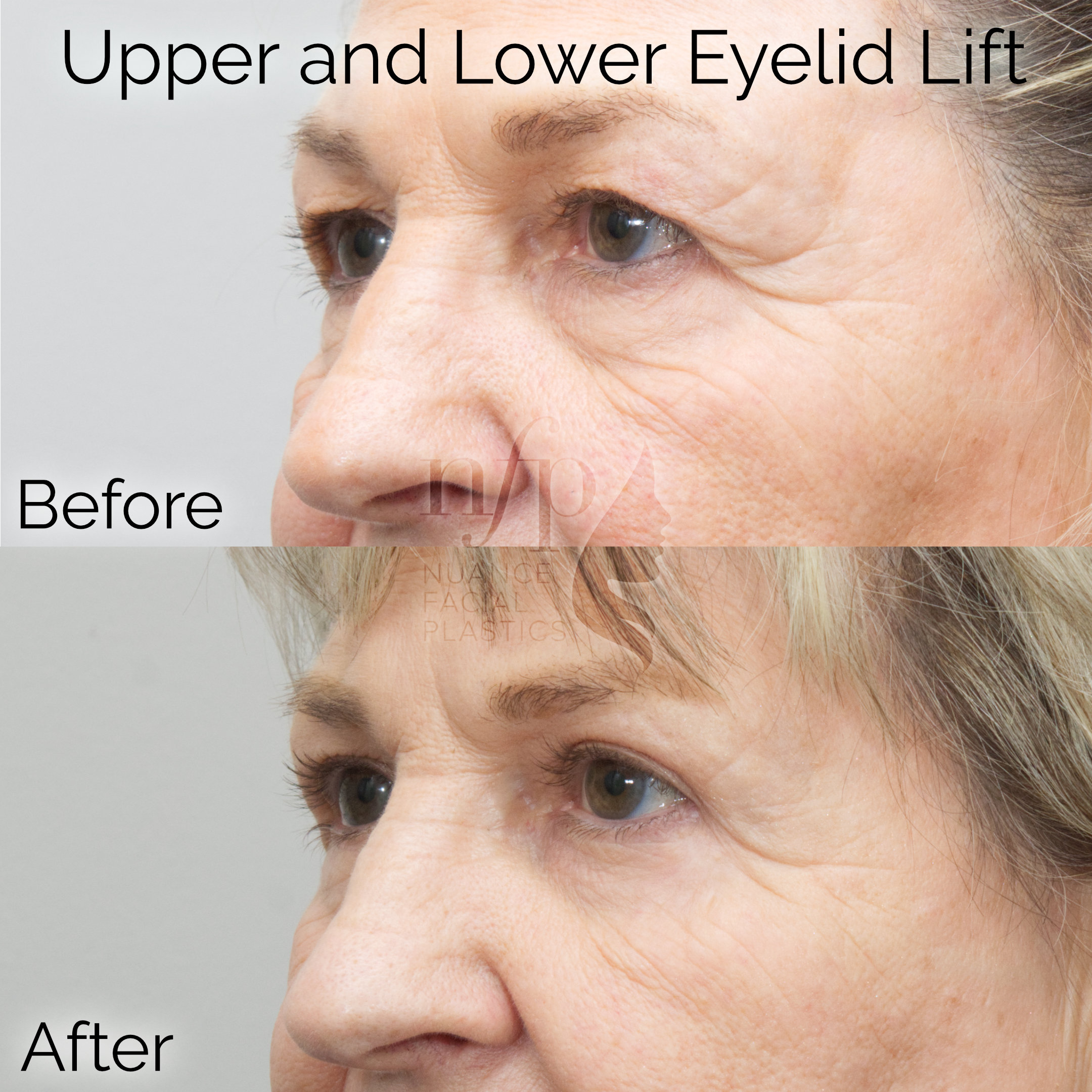 Left Oblique View of Upper and Lower Eyelid Lift