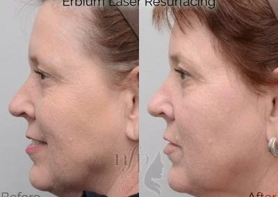 fractional erbium laser before and after