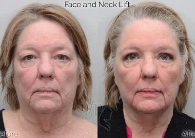 before and after face neck lift facelift
