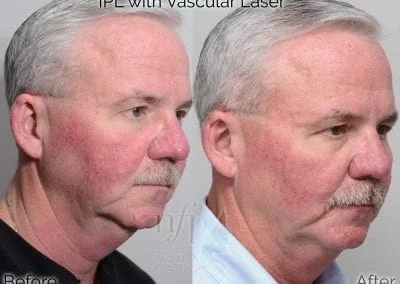 Before and After IPL vascular laser