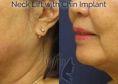 before and after neck lift chin implant