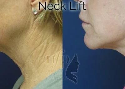 before and after face neck lift facelift