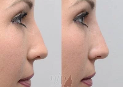 Before and After non surgical rhinoplasty