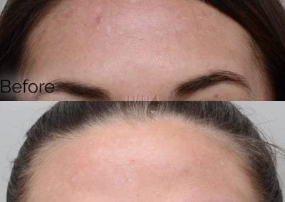 before and after obagi blue peel