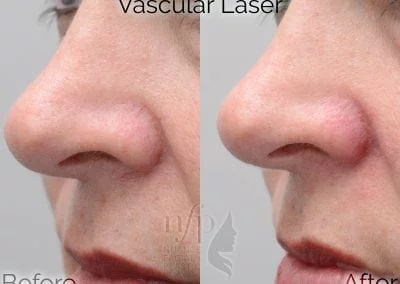 before and after facial vein treatment
