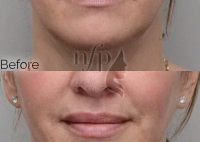 Volbella is a great product for lasting volume in the lips. As seen here, a "dehydrated" look can be converted into a "plump" look while keeping the results natural appearing.
