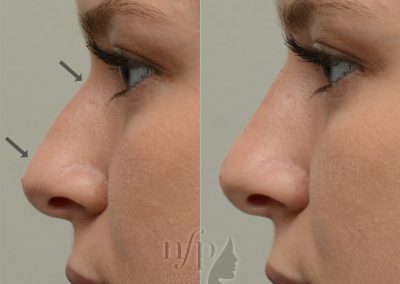 Straightened profile with a non-surgical rhinoplasty