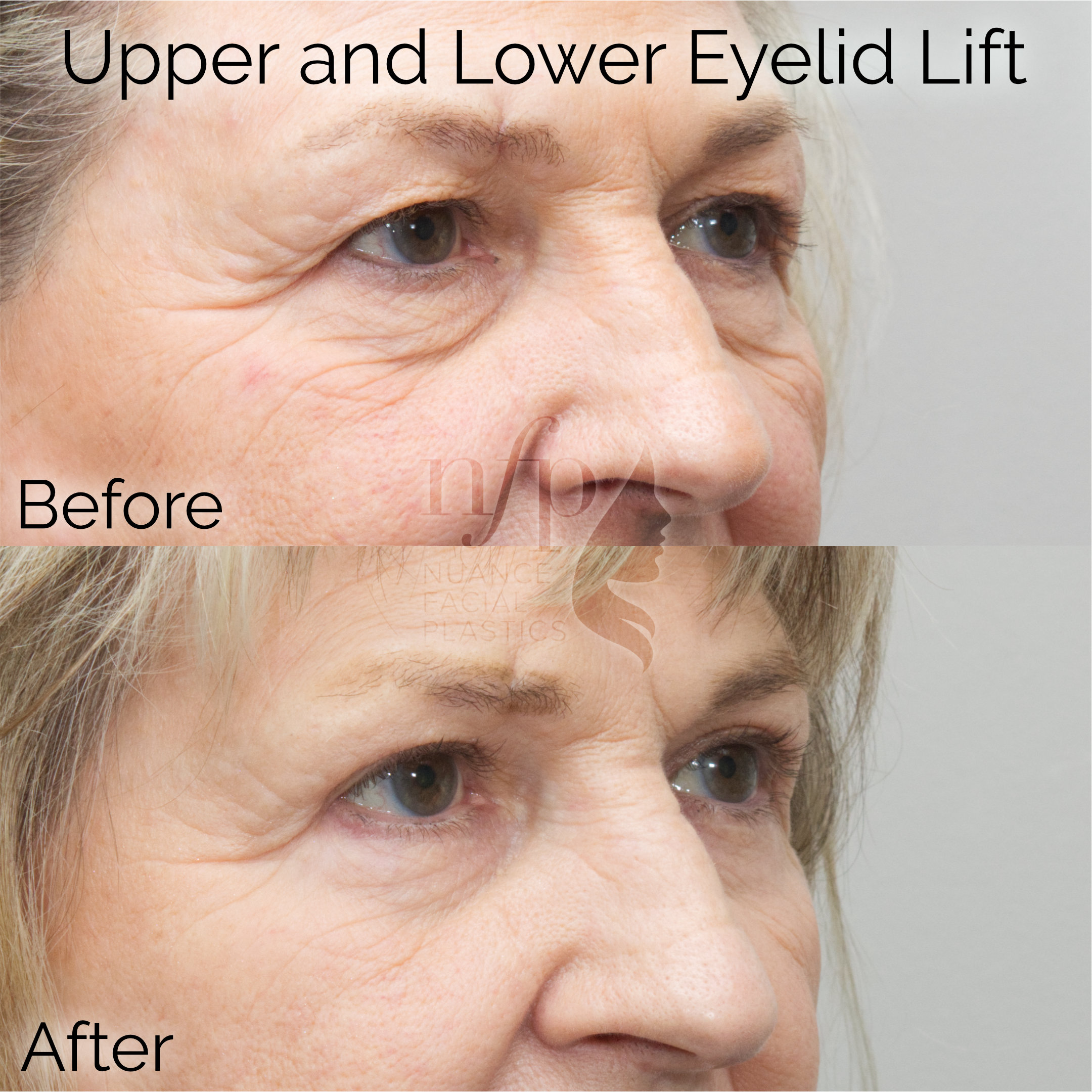 Right Oblique View of Upper and Lower Eyelid Lift