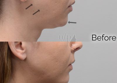 chin and jawline filler