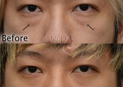 front view of scarless lower eyelid lift