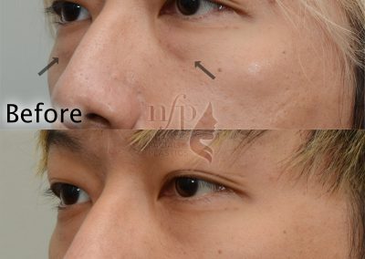 lower eyelid lift oblique view