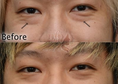 smiling view of lower eyelid fat bags